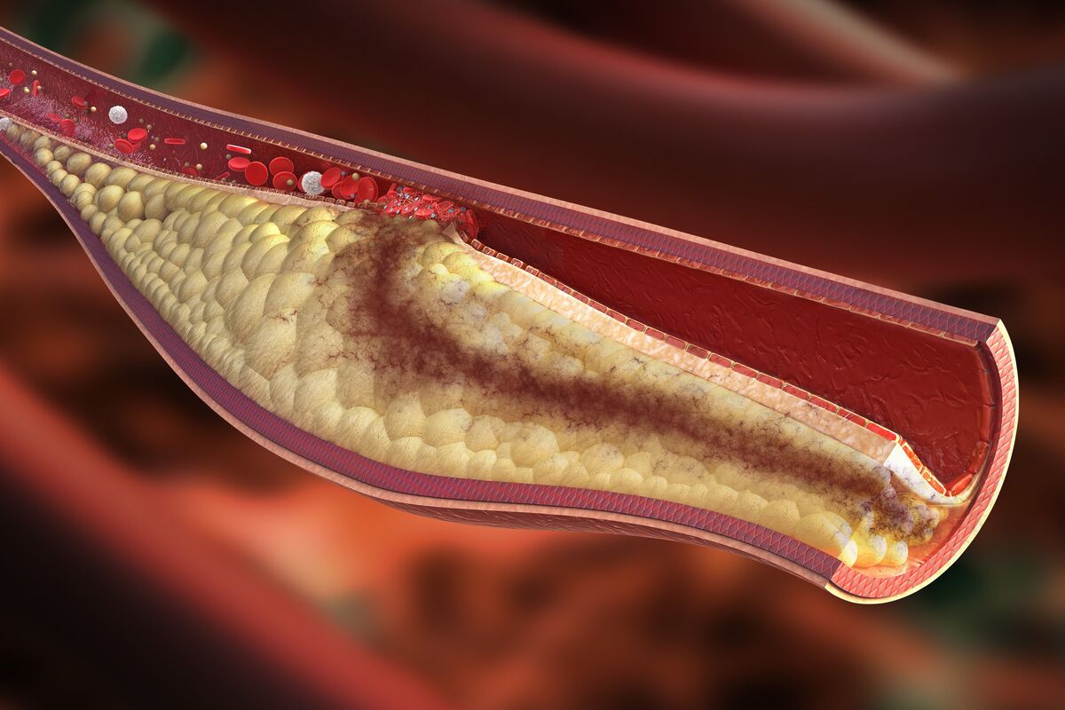 High Cholesterol