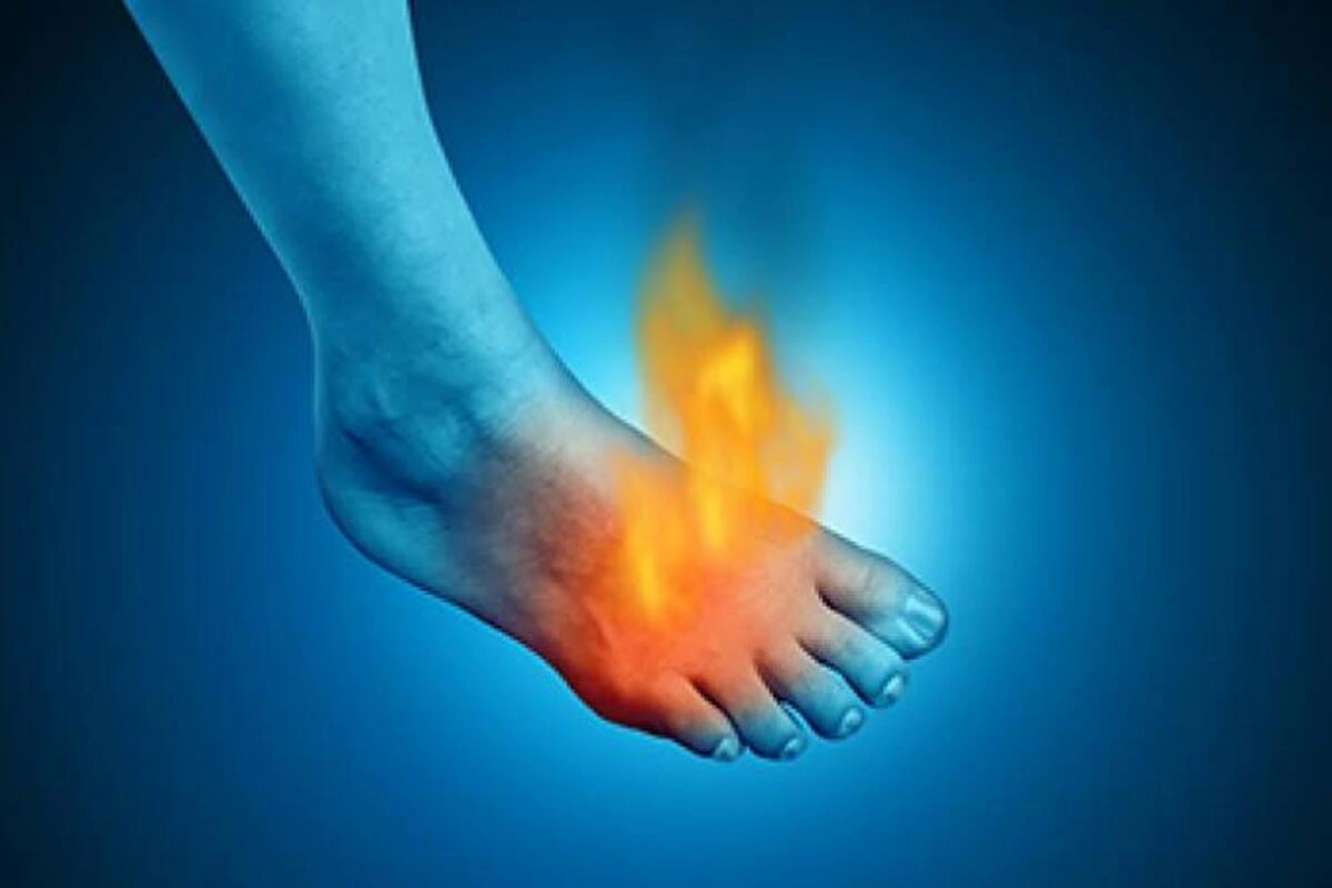 Burning feet