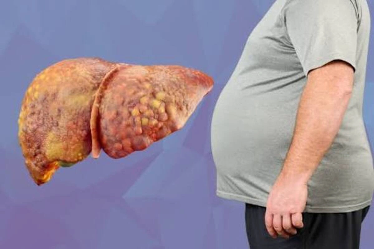 Fatty liver